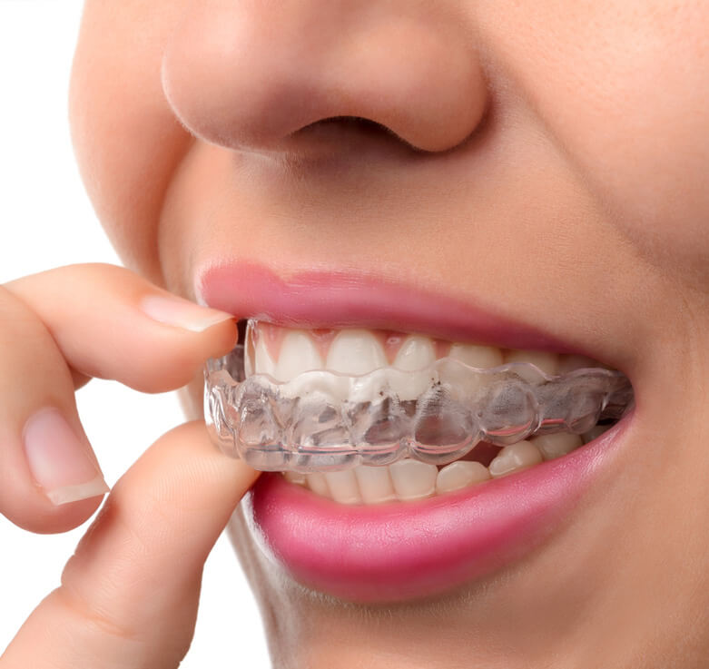 image of Woman wearing orthodontic silicone trainer