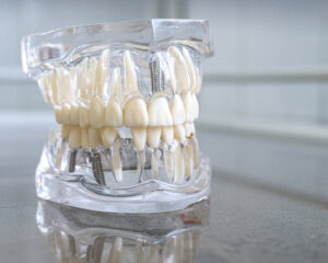 The image shows a close-up of a dental model, white plastic teeth to represent the signs you need dental implants.